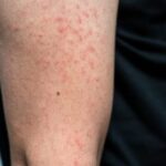 Saúde de Três Lagoas alerta sobre importância da vacinação contra o sarampo para viajantes internacionais