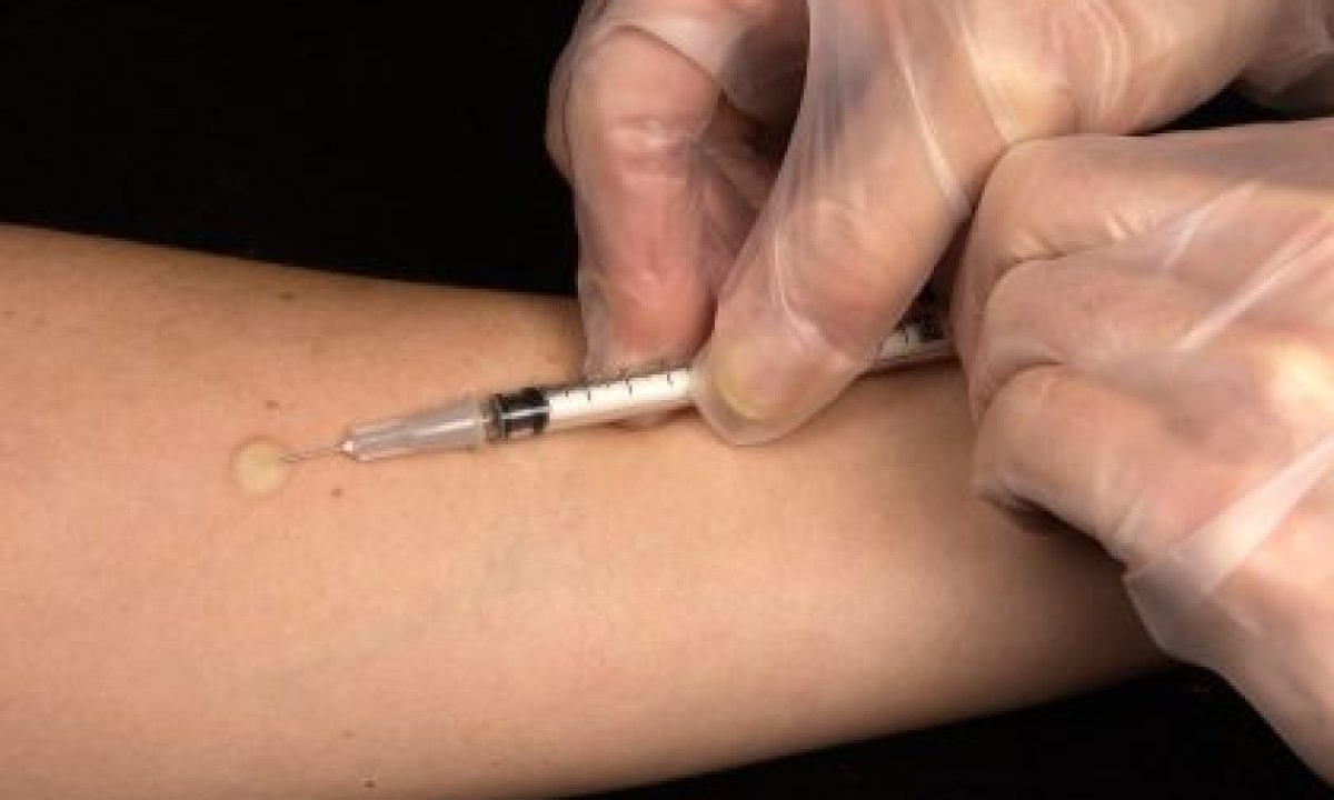 Mantoux_tuberculin_skin_test-scaled-420x280_c