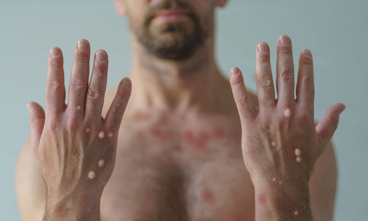 Orientacoes-para-Prevencao-e-Controle-da-Monkeypox-nos-servicos-de-Saude-site