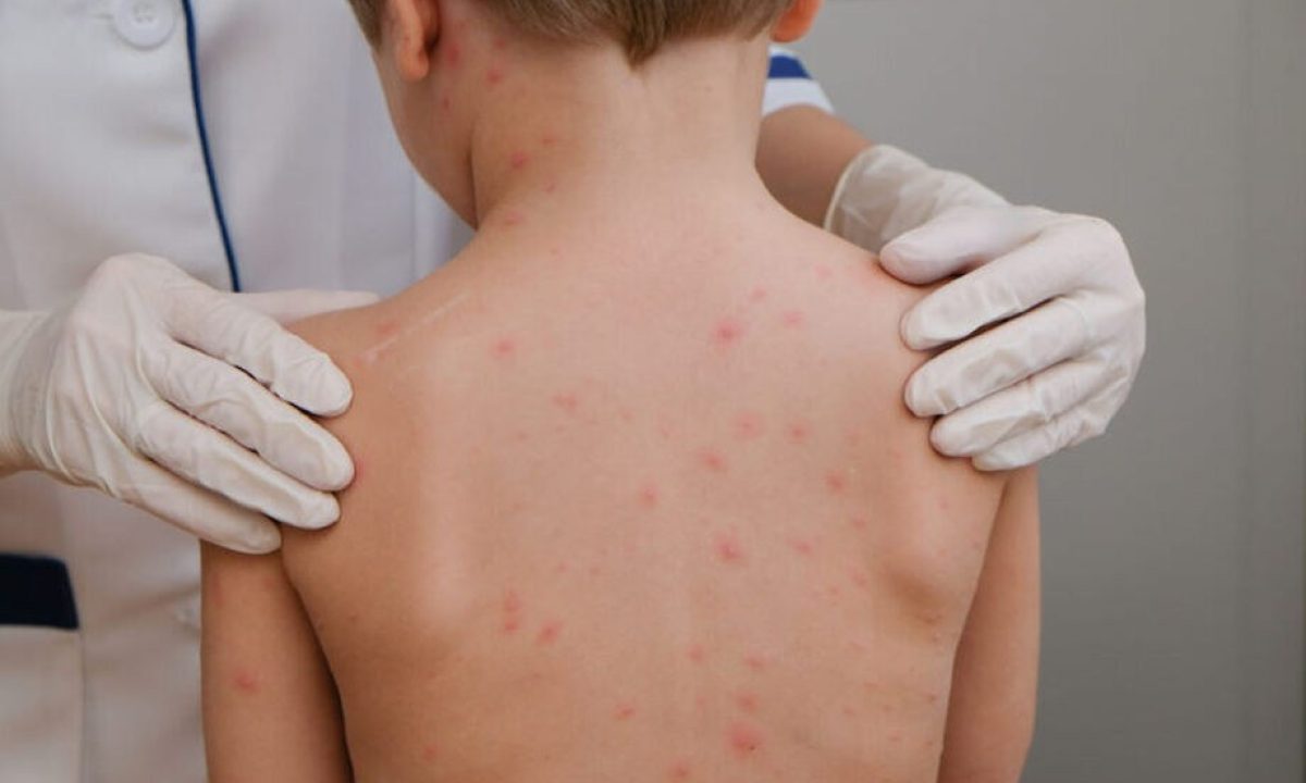 crianc-a-meningite-meningoco-cica