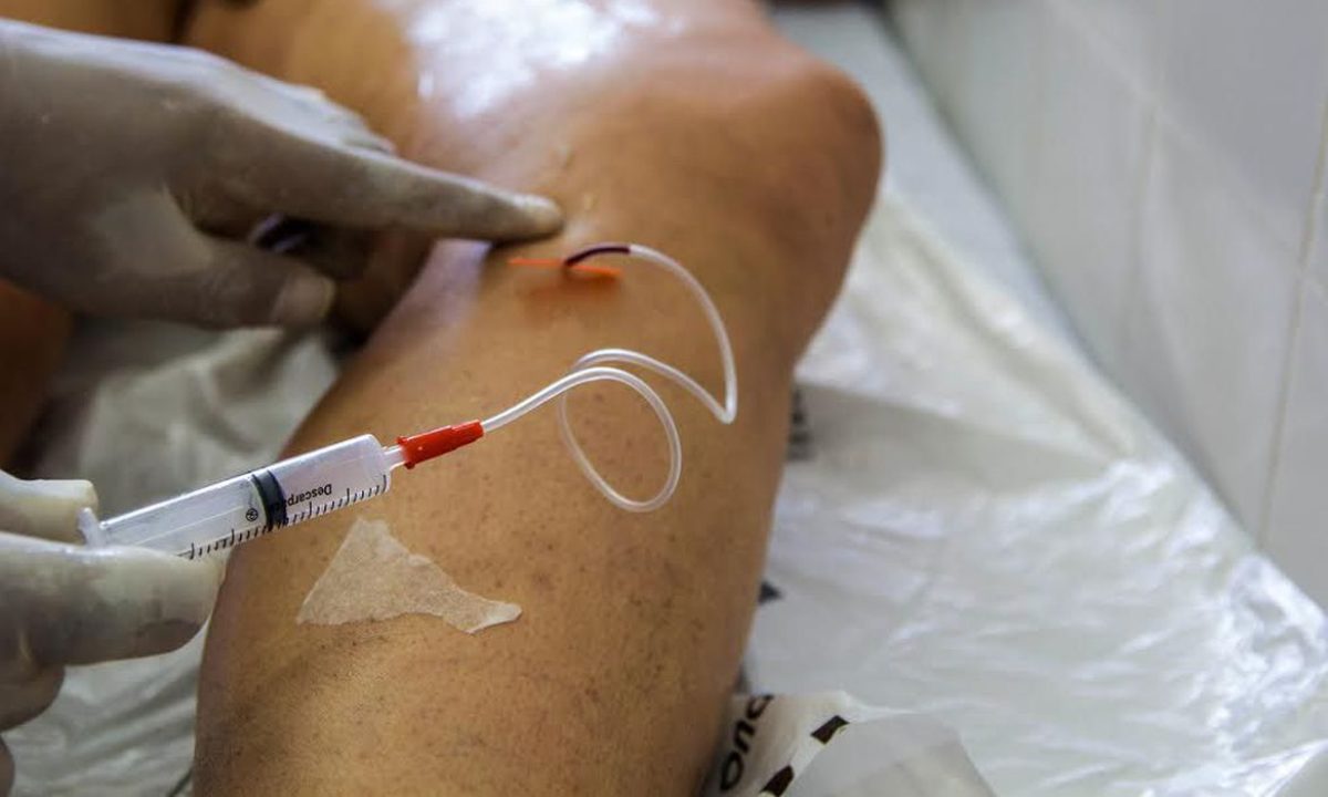 procedimento para tratamento de varizes